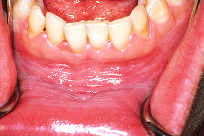 white gums